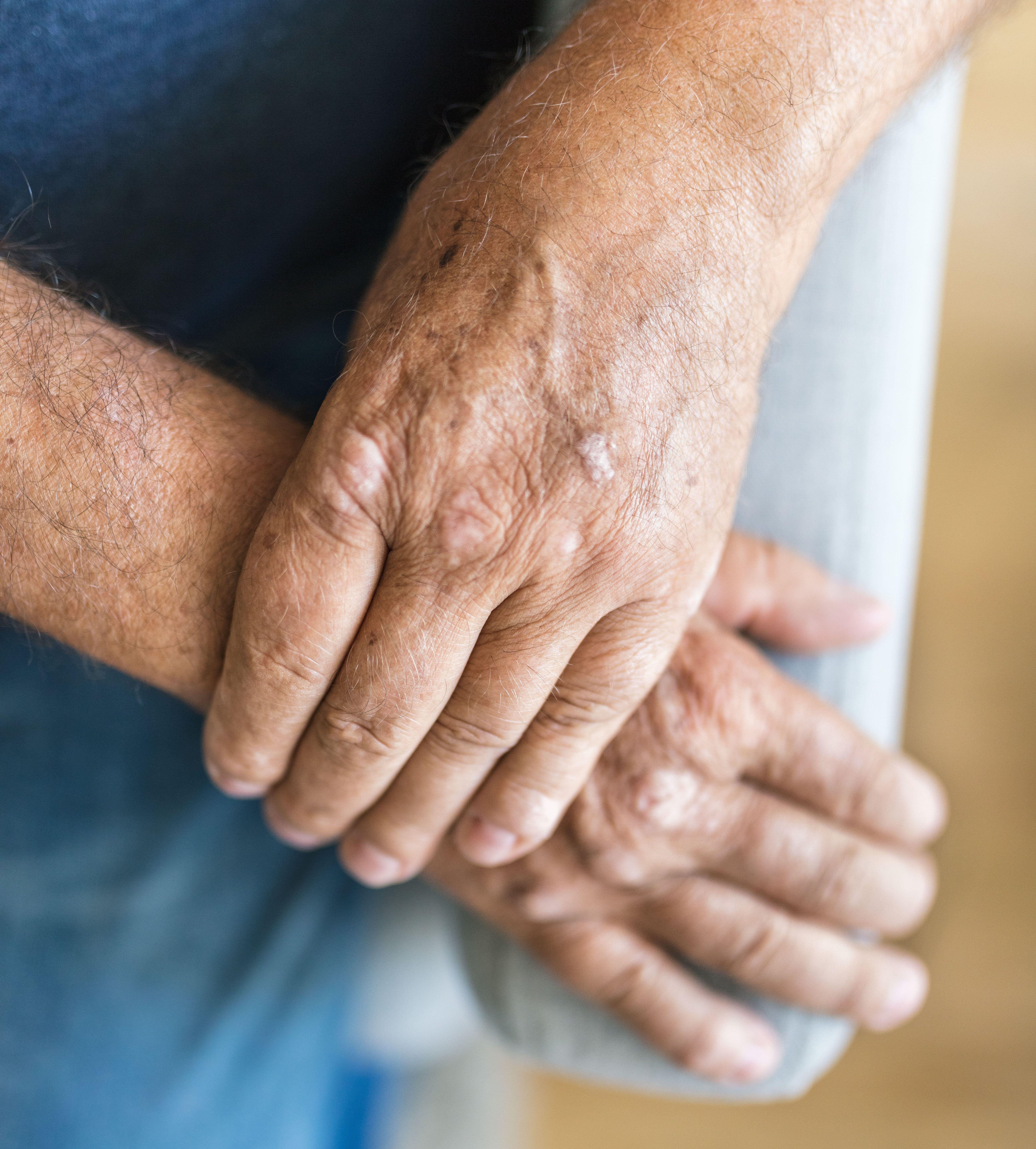 Understanding Psoriatic Arthritis: Early Symptoms and Treatment Approaches