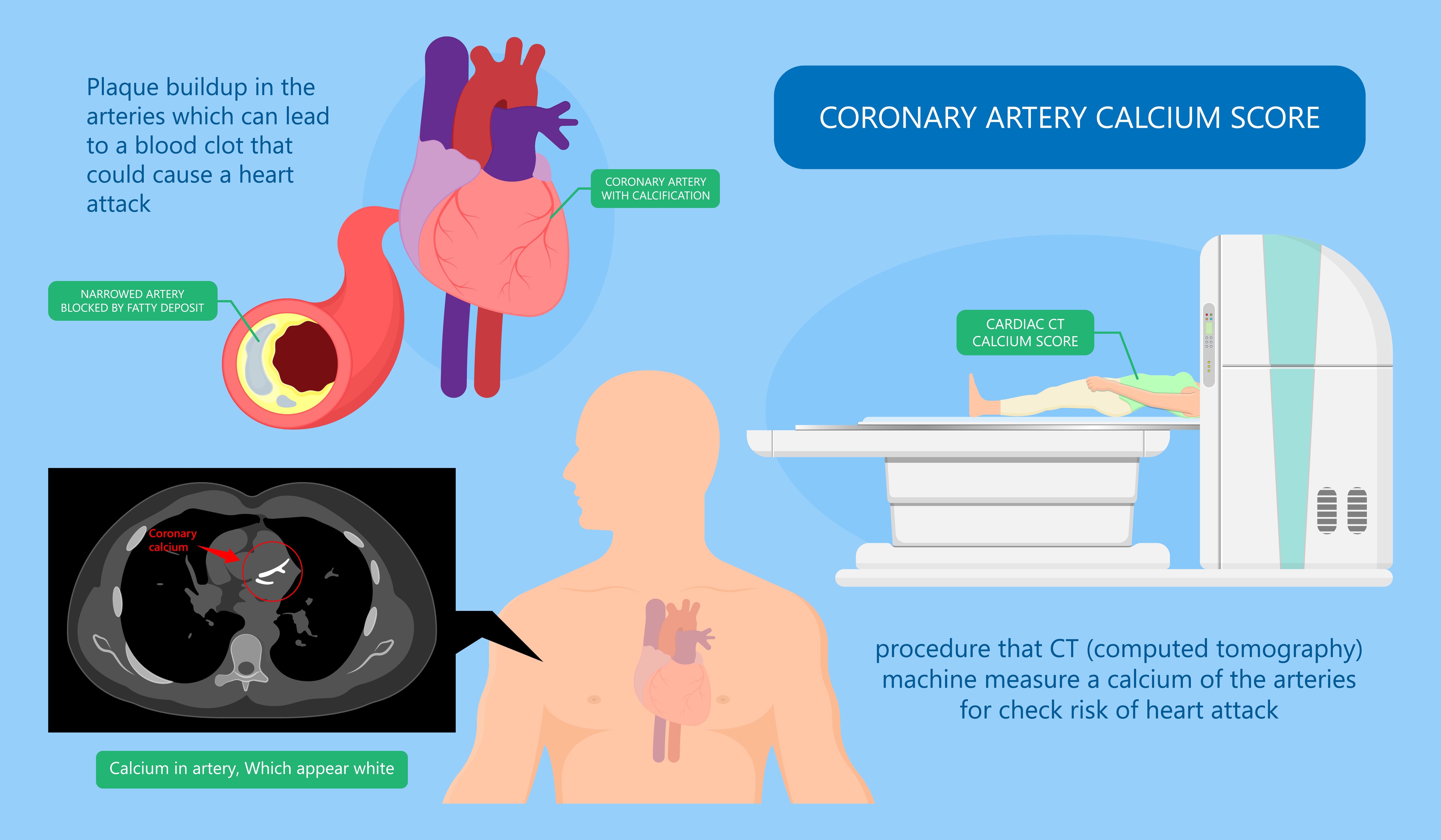 Understanding Coronary Calcium Score and Its Importance