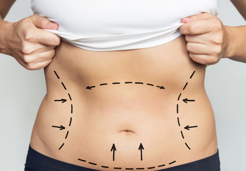 Modern Liposuction: Efficient, Minimal Scarring, Personalized Results