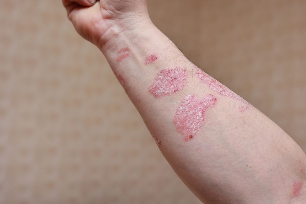 Exploring Plaque Psoriasis: Key Factors and Management