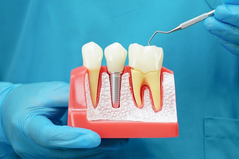 How Dental Trials Are Transforming Implant Dentistry